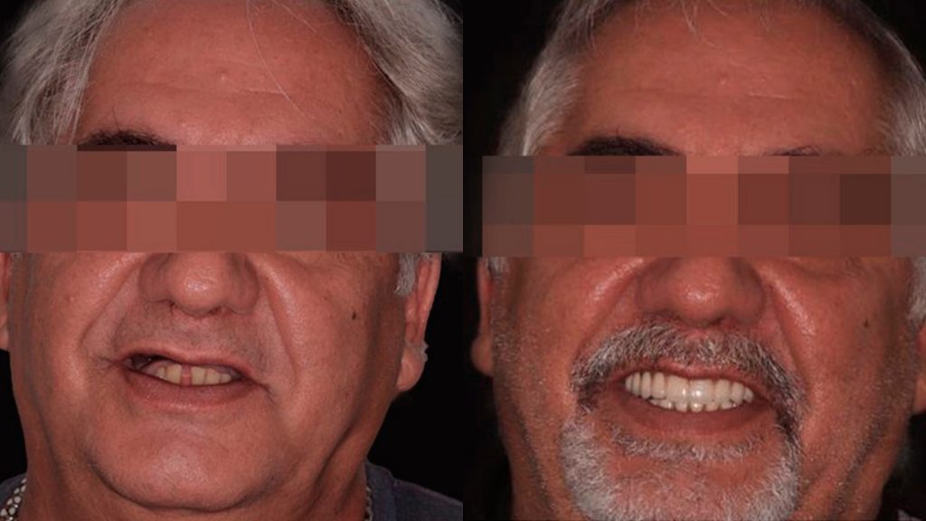 Rehabilitación Implantosoportada Bimaxilar