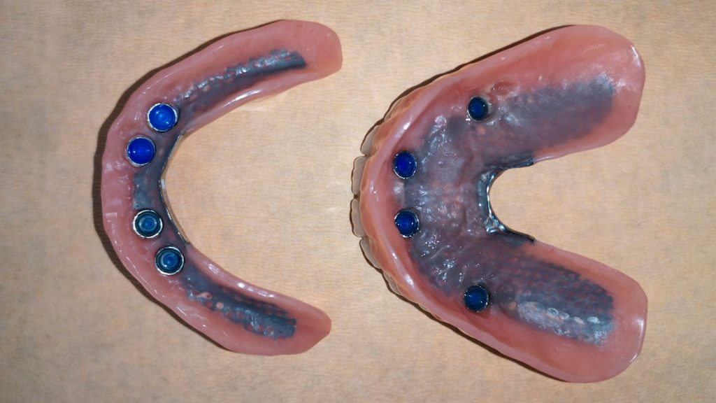 Sobredentadura